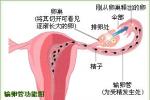 輸卵管阻塞
