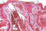 匍行性血管瘤