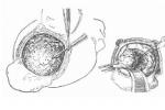 生乳頭汗管囊腺瘤