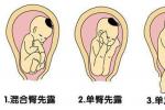 胎位異常
