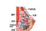 乳腺導管瘤