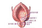 慢性膀胱炎