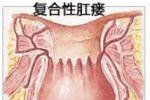 肛瘺
