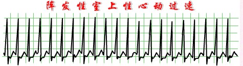 陣發性室上性心動過速