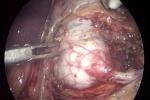 小兒腎積水