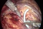 小兒腎積水