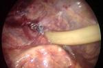 小兒腎積水