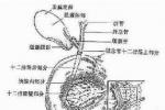 小兒急性膽囊炎