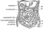 小兒繼發性腹膜炎