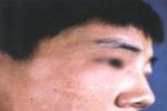 白色糠疹