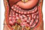 急性腹膜炎