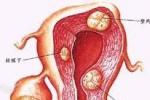 急性腹膜炎