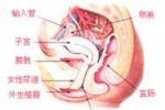 急性腹膜炎