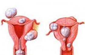 妊娠合並子宮肌瘤