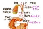 膽總管結石 膽總管結石