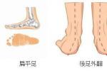 膝外翻