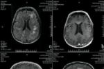 病毒性腦膜炎