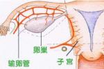 附件炎