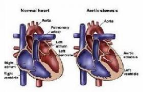 主動脈瓣狹窄