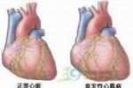 小兒擴張型心肌病