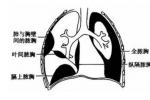 急性膿胸