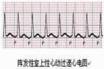 小兒竇性心動過速