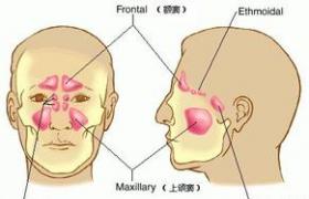 鼻竇炎