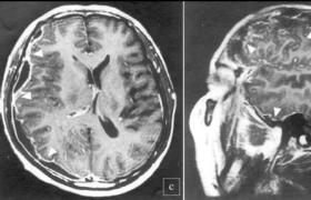 小兒化膿性腦膜炎