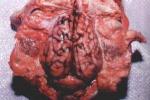 小兒化膿性腦膜炎