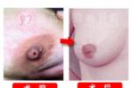 濕疹樣癌