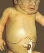 嬰兒青銅綜合征