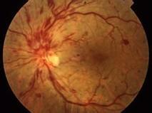 視網膜中央靜脈阻塞