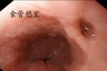 先天性食管憩室