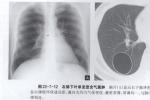 胸內異物