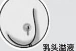 乳頭溢液