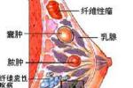 乳腺囊腫
