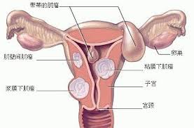子宮肉瘤