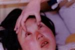 疫斑熱