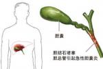 急性結石性膽囊炎