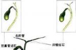 急性結石性膽囊炎