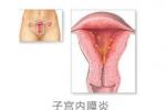子宮內膜結核