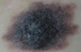 黑色素瘤