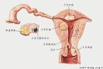 外陰腫瘤合並妊娠