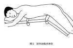 尾骨骨折與脫位
