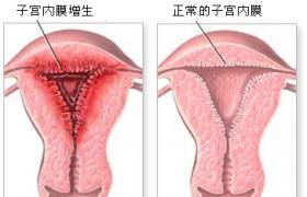 子宮內膜增生