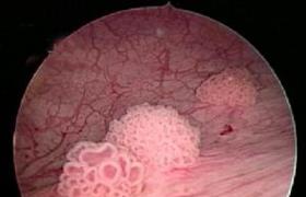 膀胱葡萄狀肉瘤