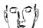 鼻中隔穿孔