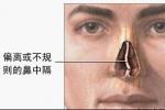 鼻中隔穿孔