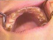 小兒牙本質生長不全綜合征