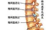 慢性腰背痛